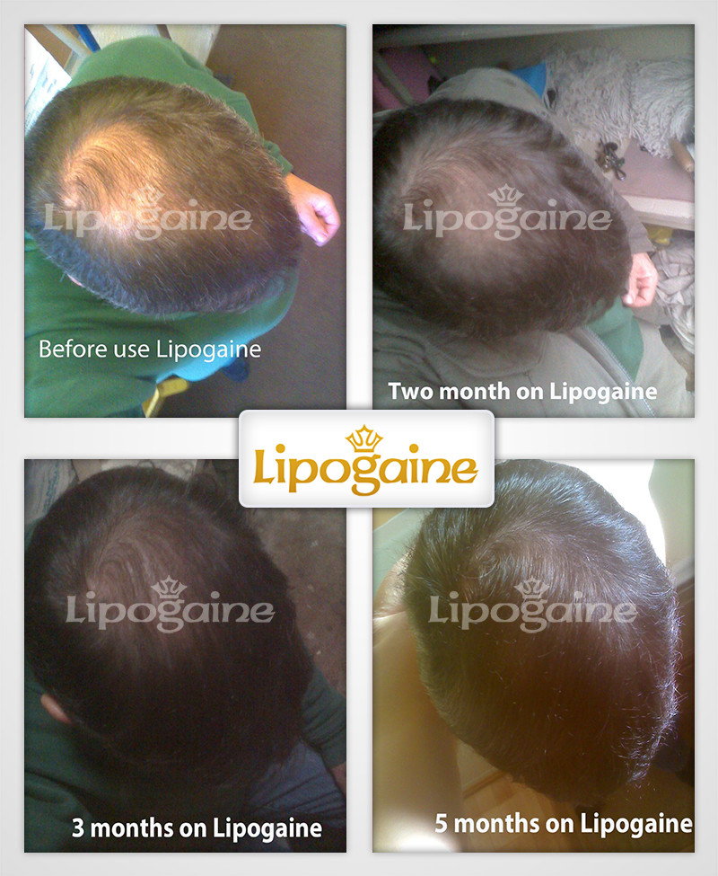 Lipogaine for Men - Image 2