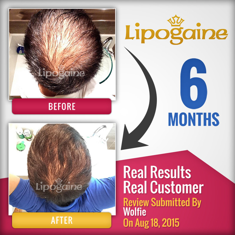 Lipogaine for Men - Image 3